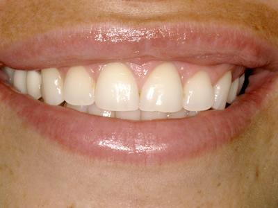 Cos'è l'implantologia dentale